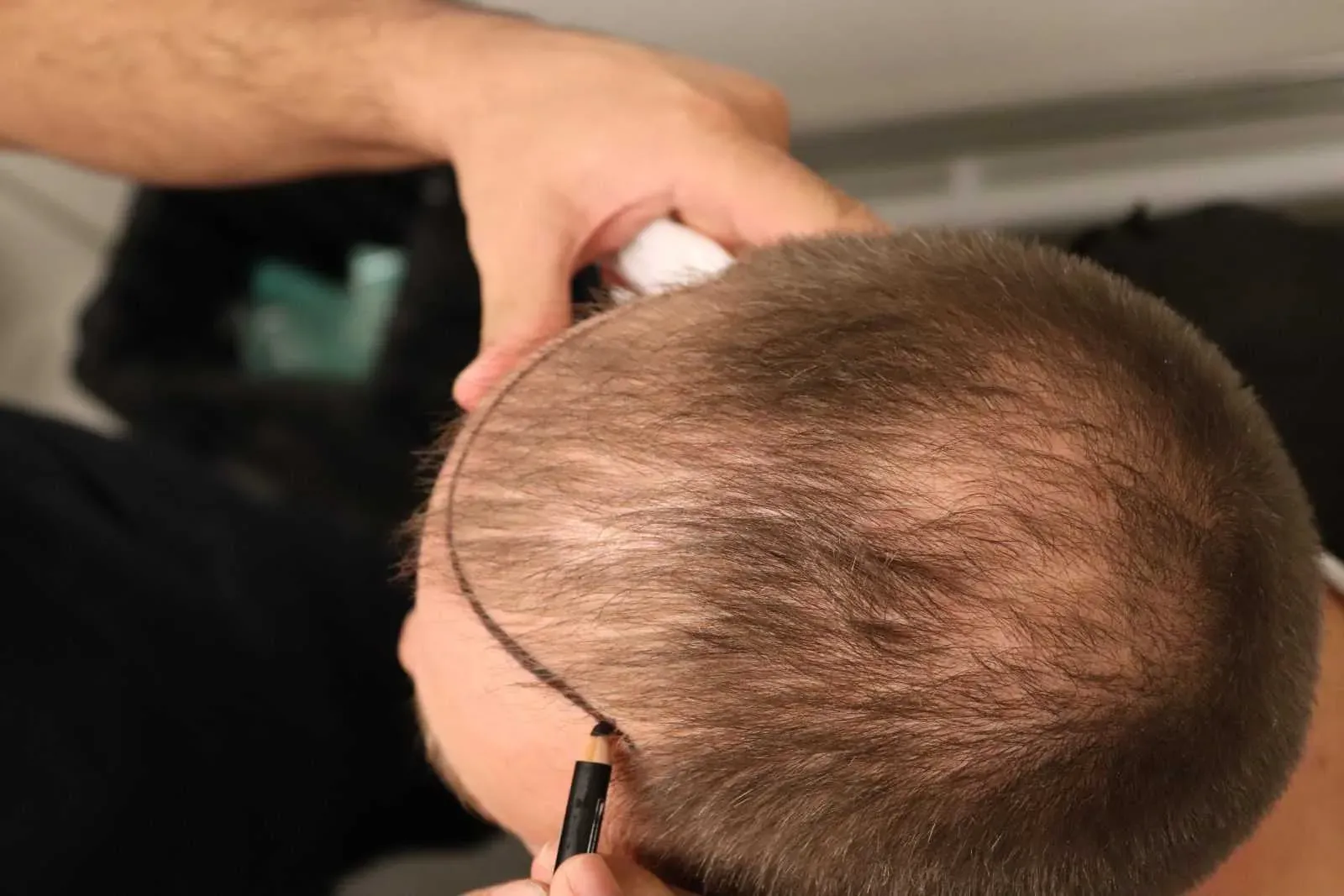 Specialist ritar hårfästlinje på patients huvud inför hårtransplantation på 85 Kliniken