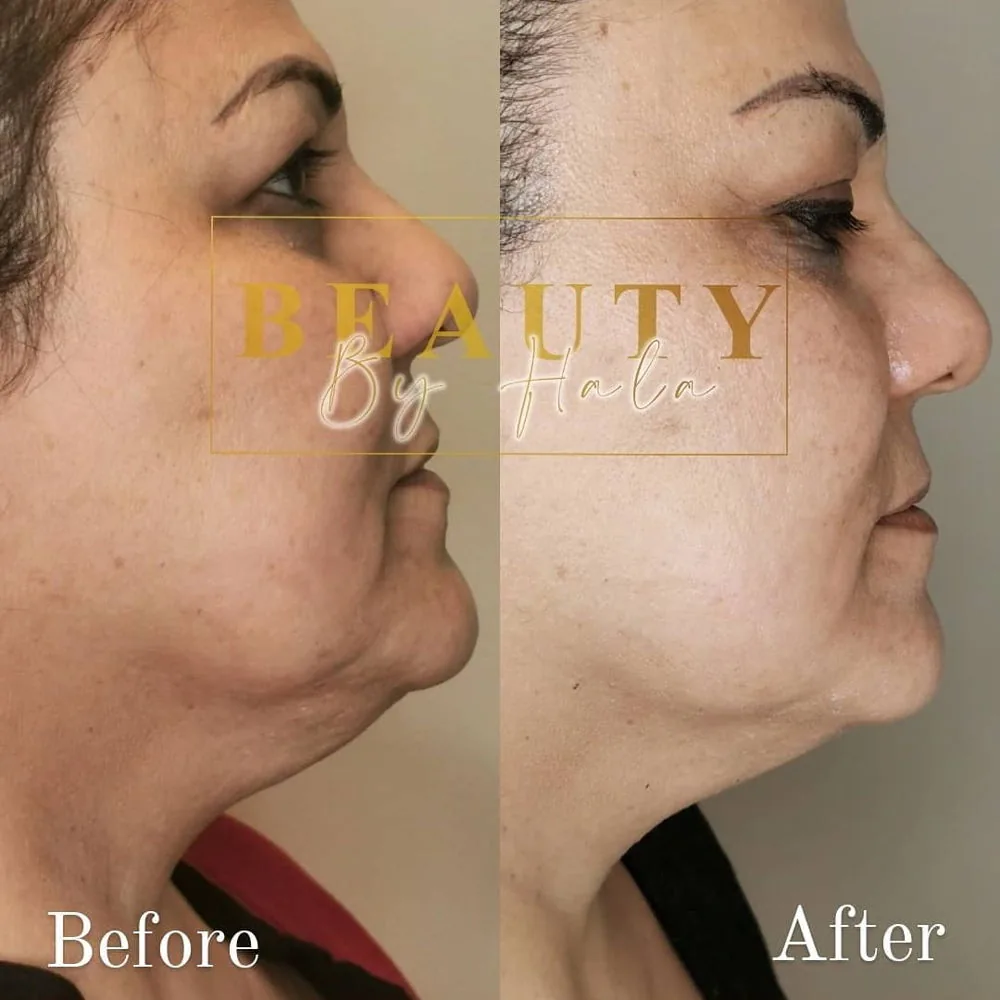 Före och efter HIFU-behandling av käklinje och hals hos Beauty by Hala Skincenter i Göteborg