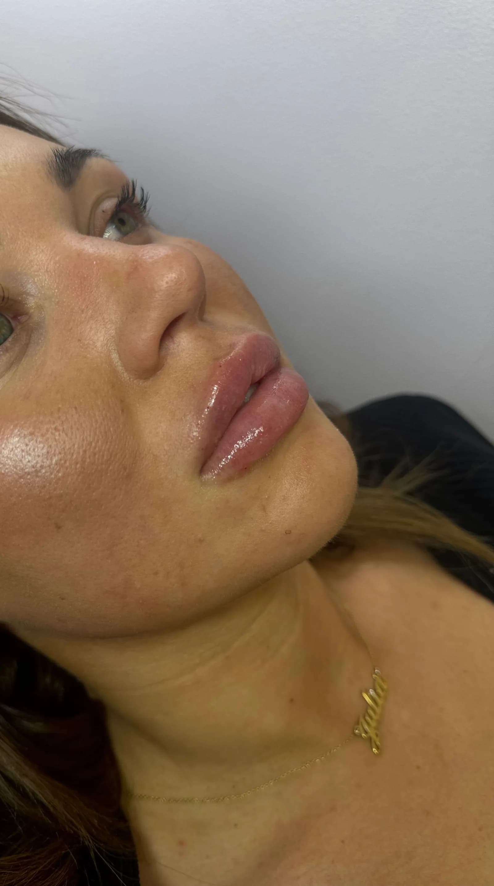 Läppfillers hos Beauty Deluxe på Birger Jarlsgatan 46 i Stockholm