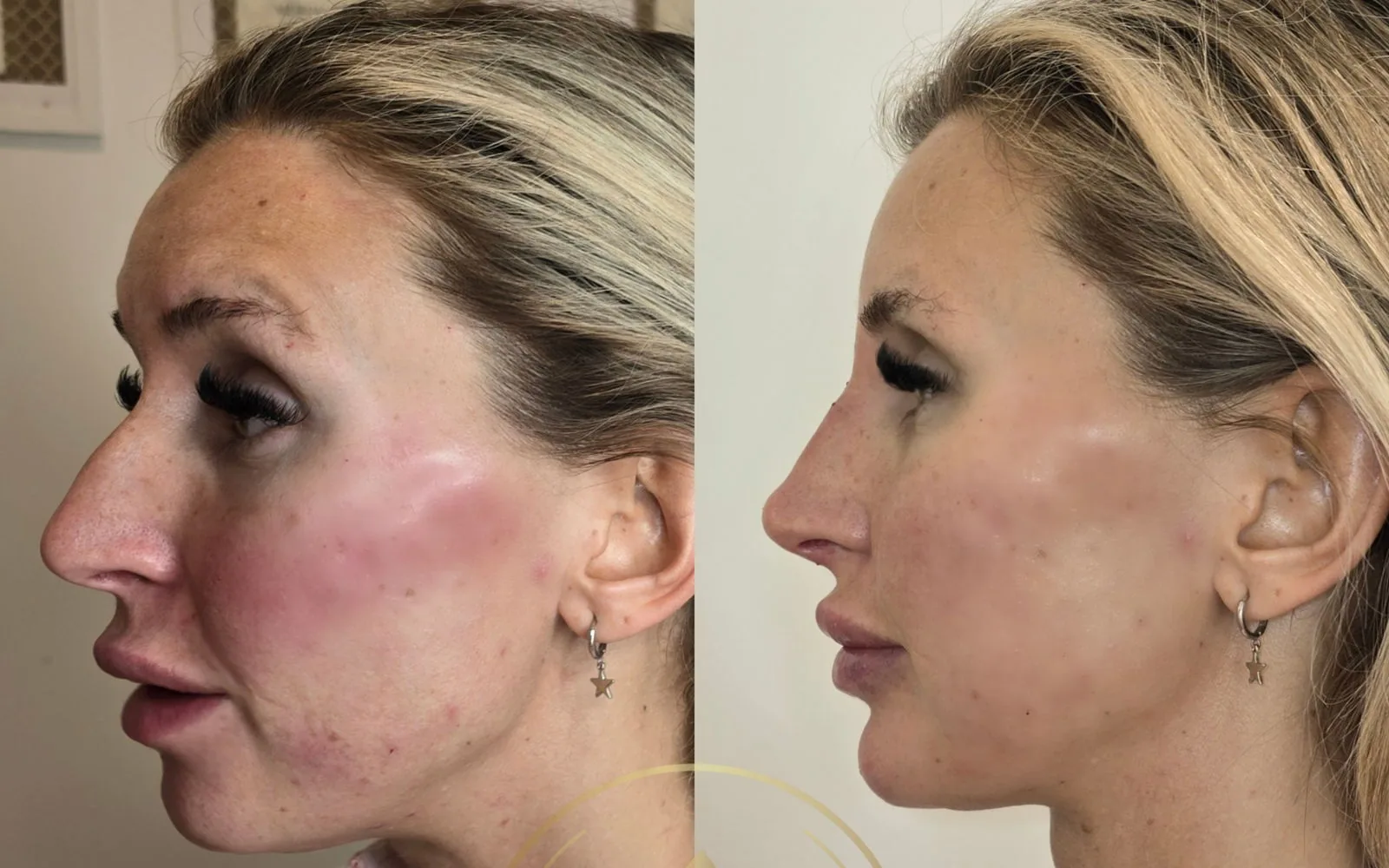 Före och efter injektionsbehandling hos BeautyPhi i Malmö