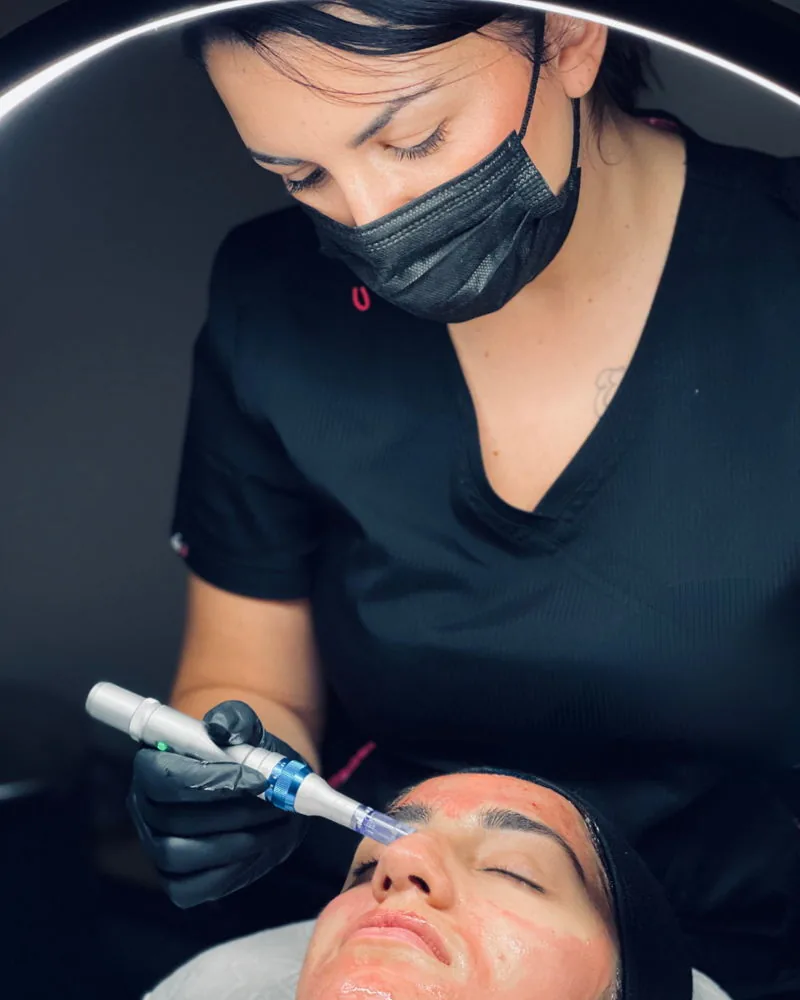 Microneedling med dermapen hos Before/After Clinic i Malmö