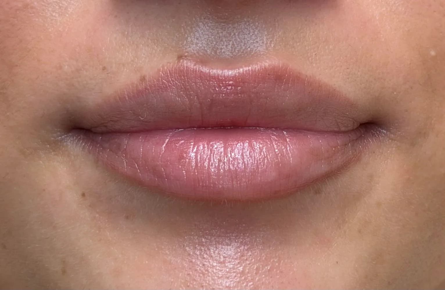 Läppar efter fillerbehandling hos Complete Esthetic i Malmö