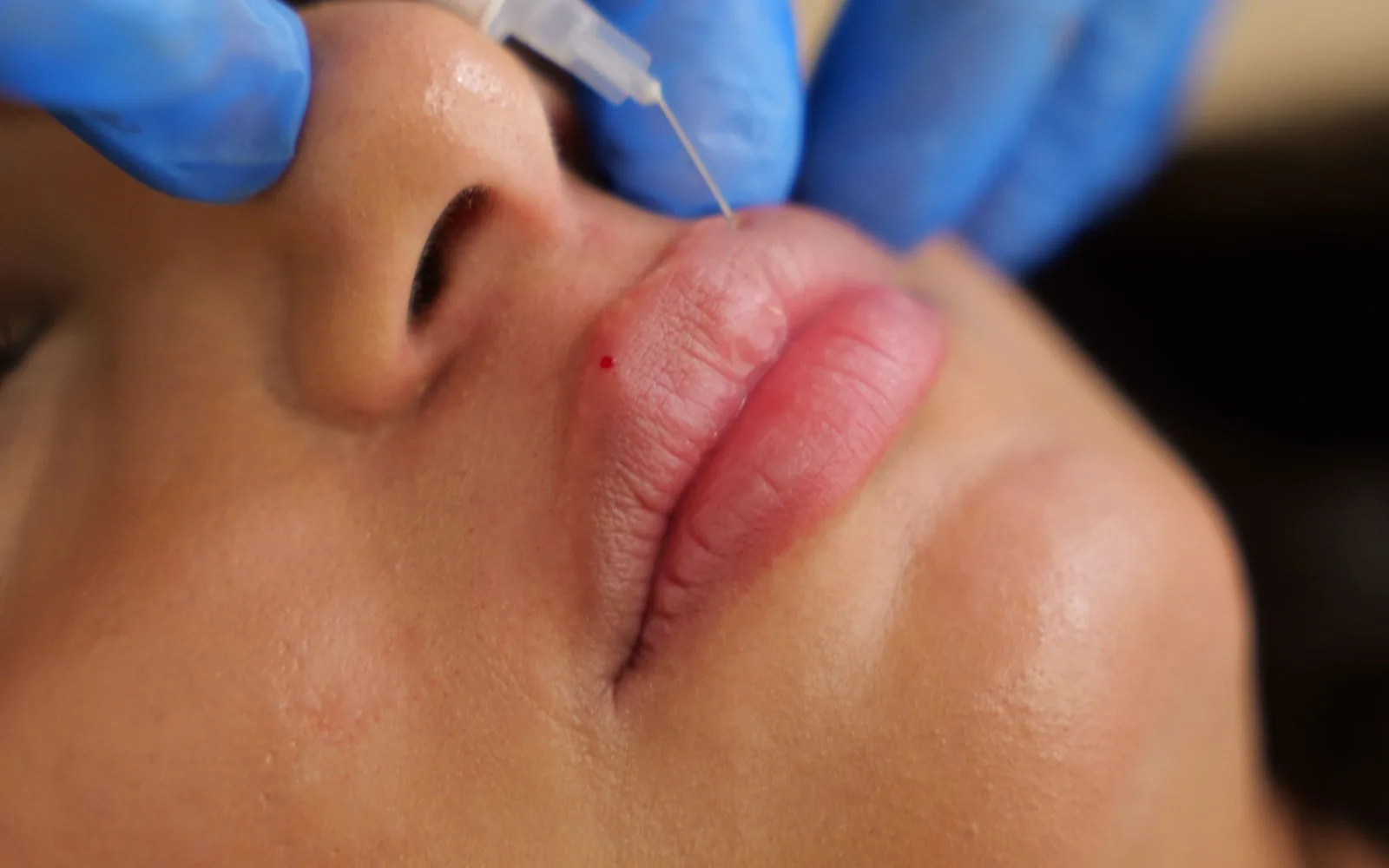 Läppbehandling med filler hos Dr. Beauty i Malmö
