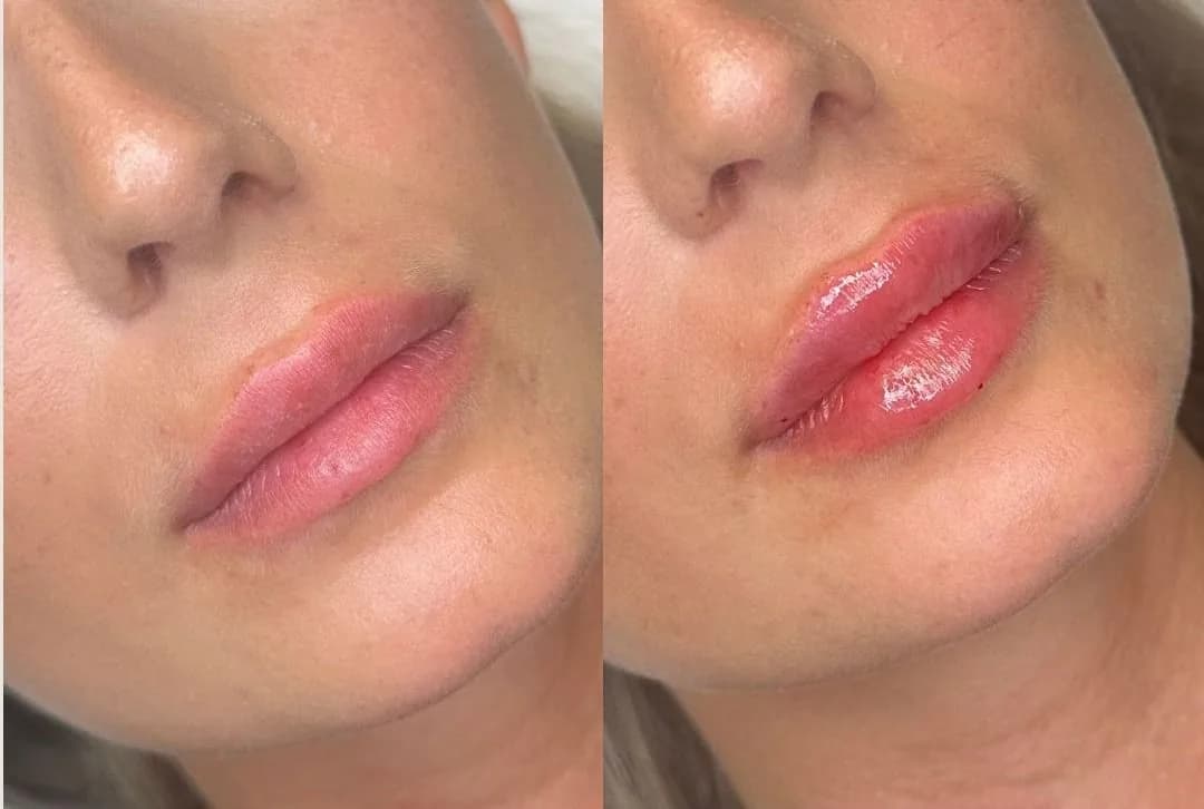 Före och efter läppfillers hos DS Estetik Klinik i Malmö
