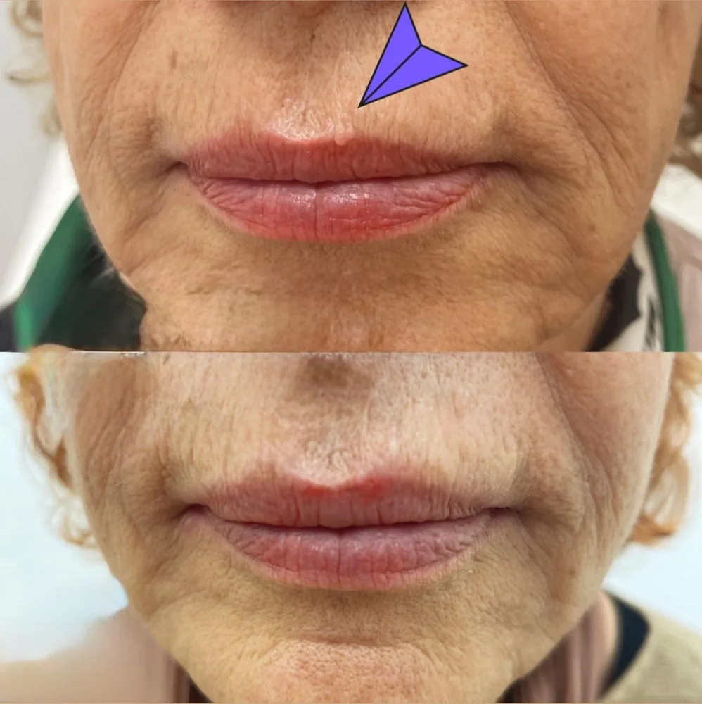Före och efter-bild av behandling runt munnen hos Health & Beauty by Dr. Lida i Limhamn