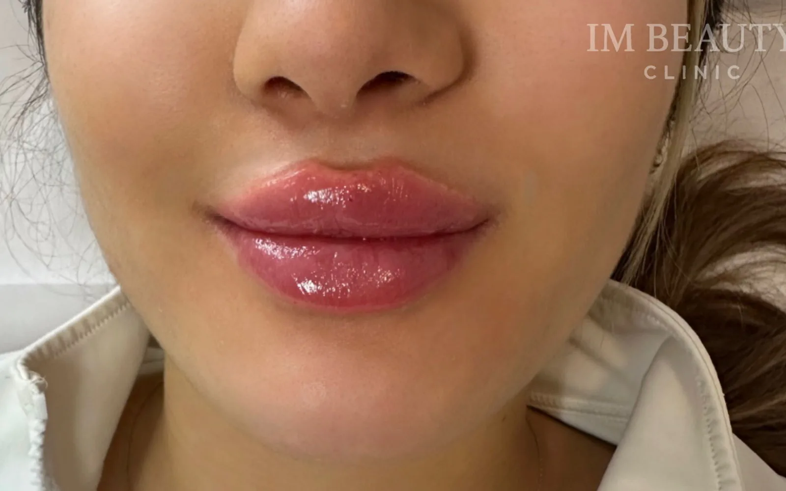 Läppfiller utfört på IM Beauty Clinic i Stockholm