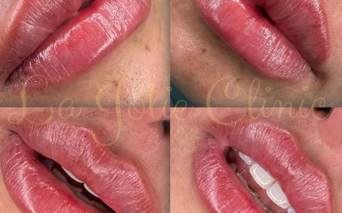 La Jolie Clinic i Malmö — estetisk klinik med fillers, botox och trådlyft