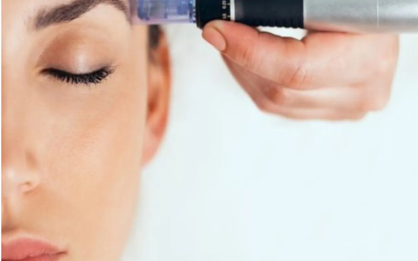 Närbild av dermapen-behandling hos Laserskincare i Göteborg