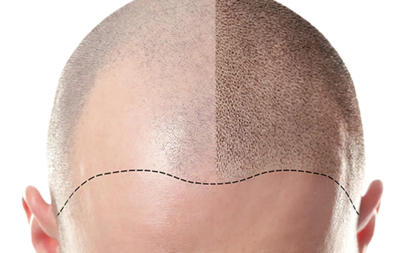 SMP-behandling hos Lella Bella i Göteborg – före och efter skalpmikropigmentering