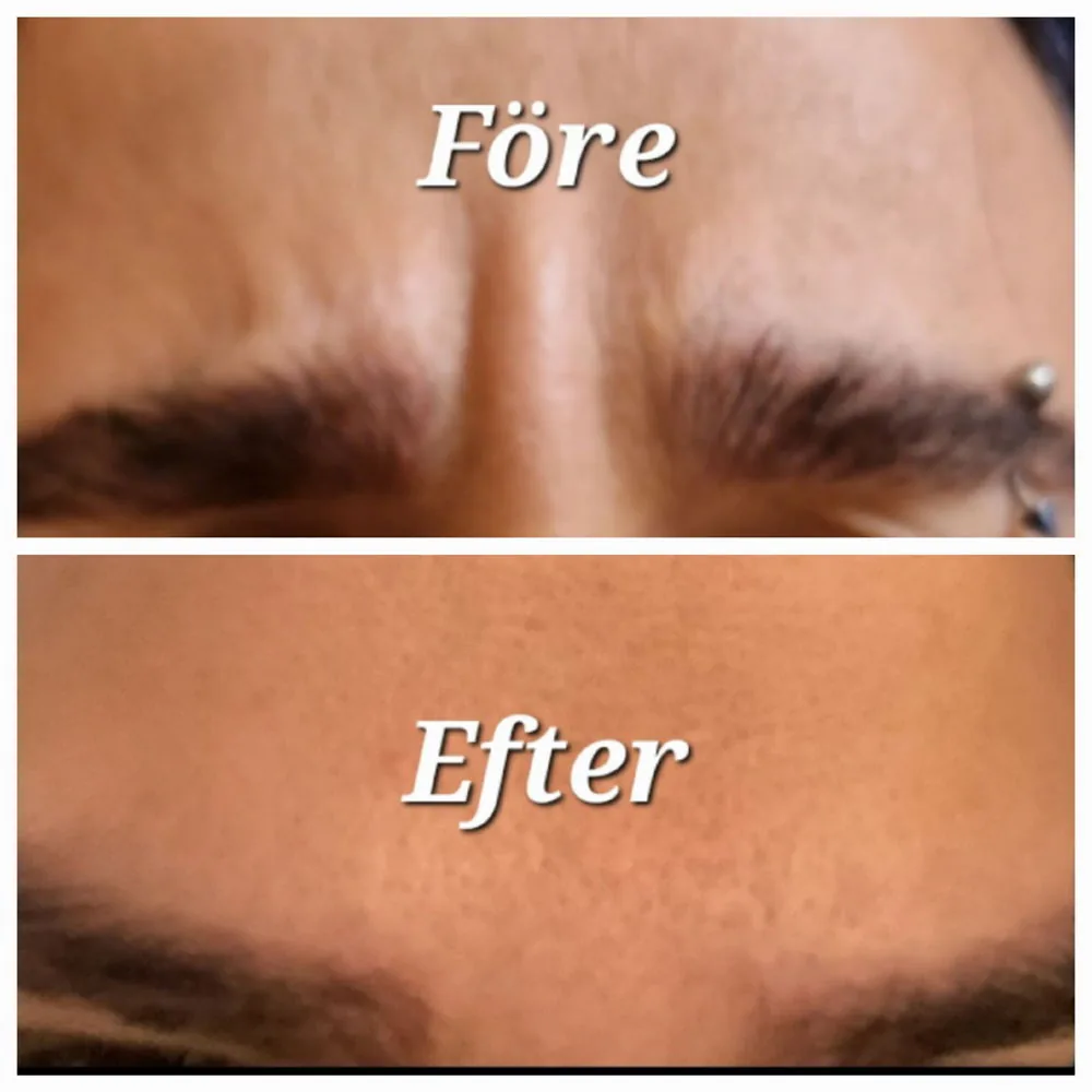 Före och efter botox i arga rynkan hos Luxe Clinic 44 i Göteborg