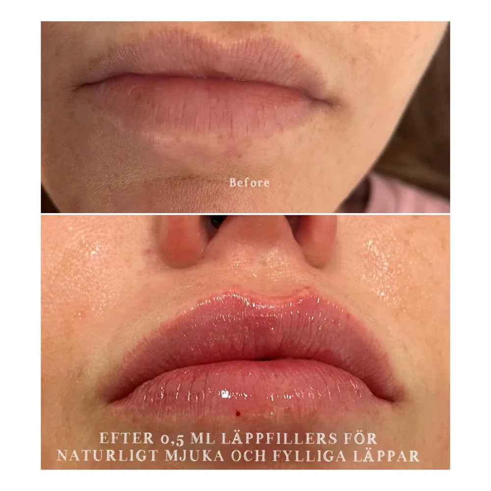 Före och efter läppfillers hos Mehraneh Beauty i Malmö