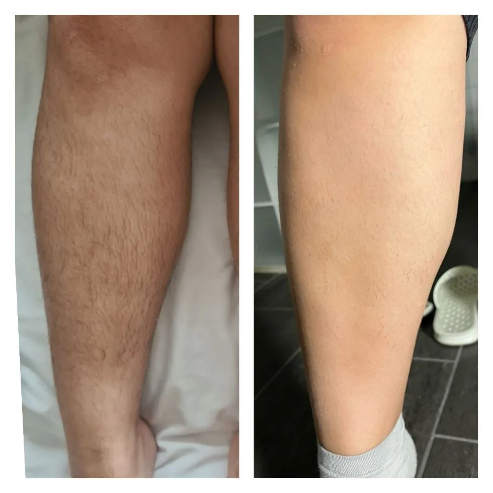 Före och efter laserhårborttagning på underben hos Ninas Laser i Malmö