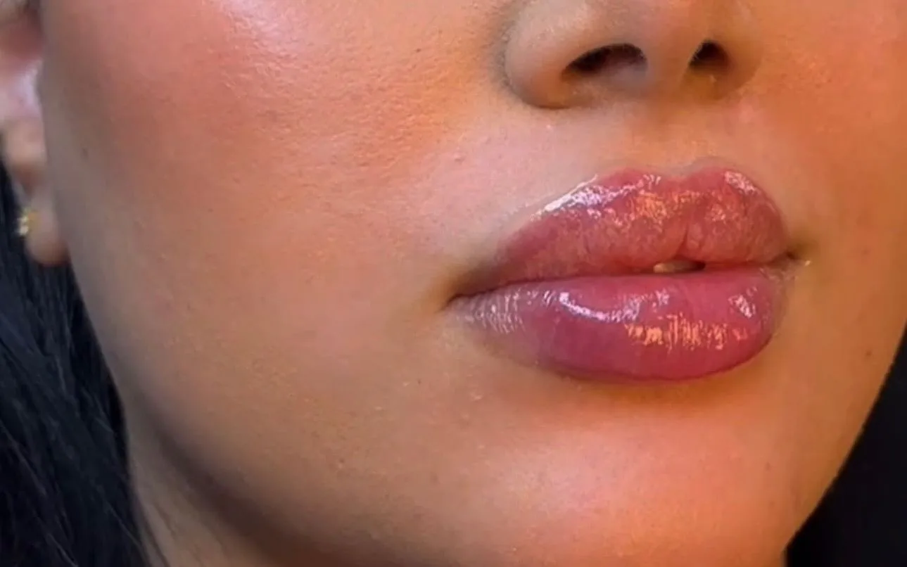 Läppar efter fillerbehandling hos NS Beauty Clinic i Västra Frölunda