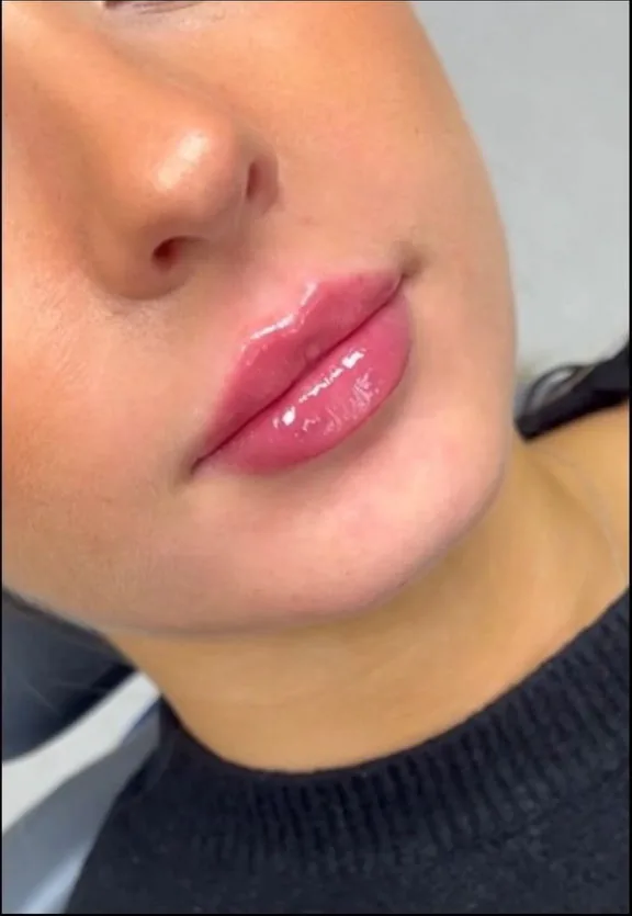 Läppar efter fillerbehandling hos SDM Derma Center Stockholm