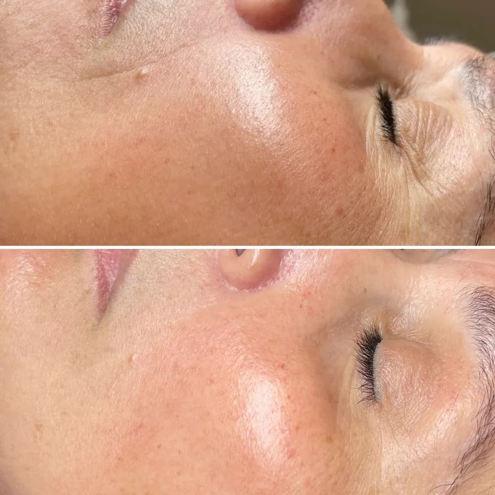 Före och efter hudbehandling hos Siguer Beauty i Göteborg