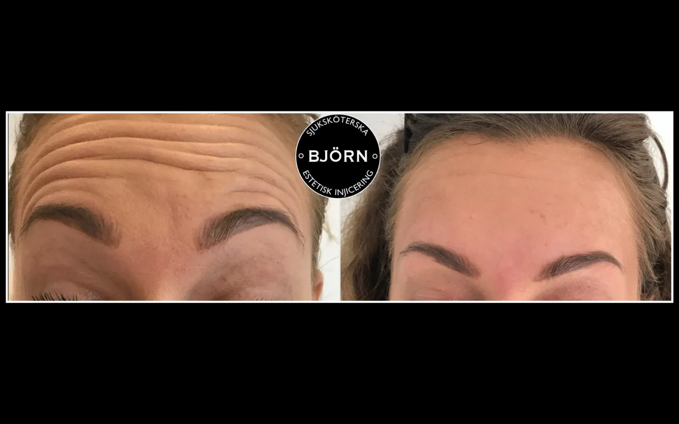 Före- och efterbild av botoxbehandling mot pannrynkor hos Sjuksköterska Björn