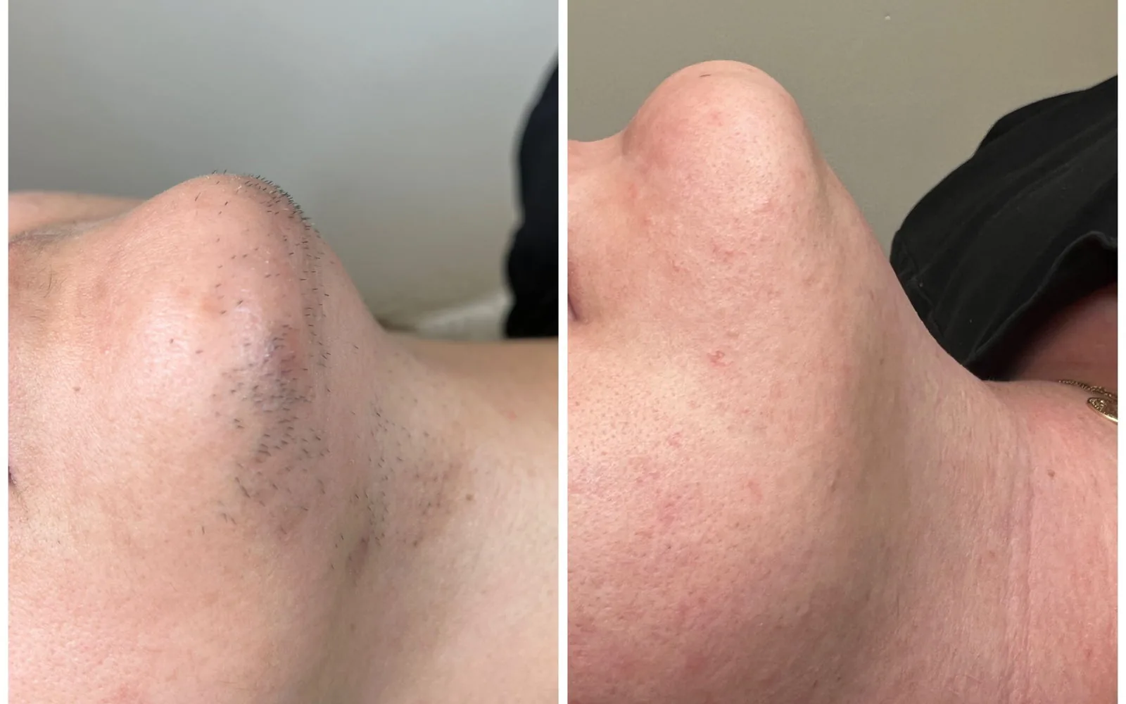 Före och efter laserhårborttagning på hakan hos Skinsoft i Malmö