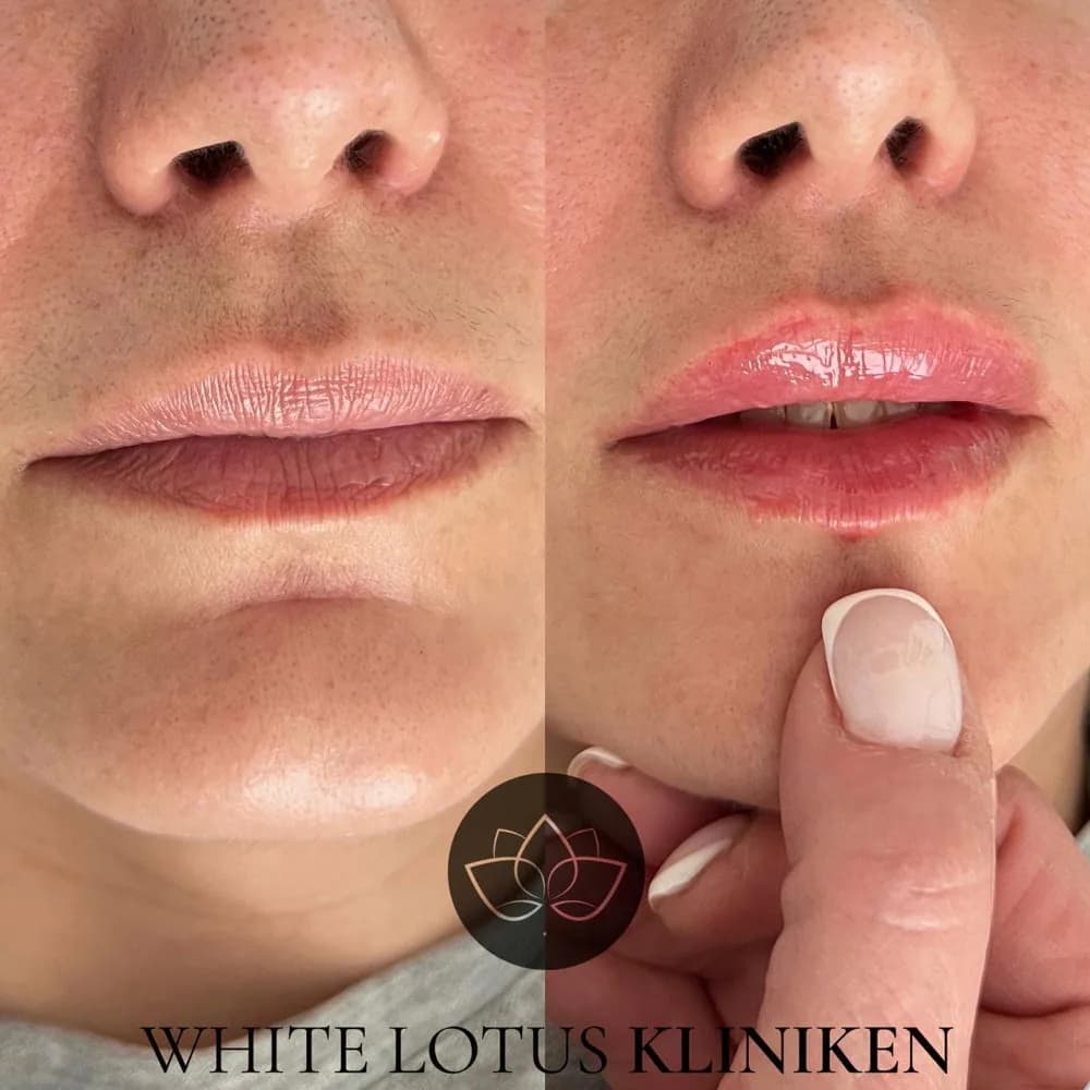 Läppar före och efter fillerbehandling hos White Lotus Kliniken i Malmö